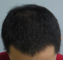 植发4个月了，期间有正常脱发