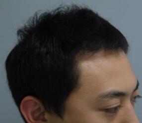 植发半年了，头发没有再掉落的情况，用手扒扯了一下，长的很牢固