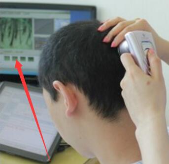 医生检查头皮和毛囊的图片