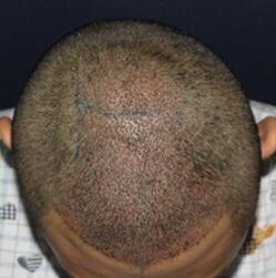 植发手术是7个医生同台手术的