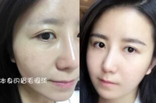 眉毛种植对比图