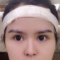 眉毛种植果和整形图片分享