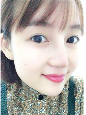 做完综合鼻修复之后鼻子更加自然了