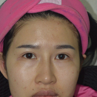 我做的面部年轻化自体脂肪面部填充大家看看怎么样