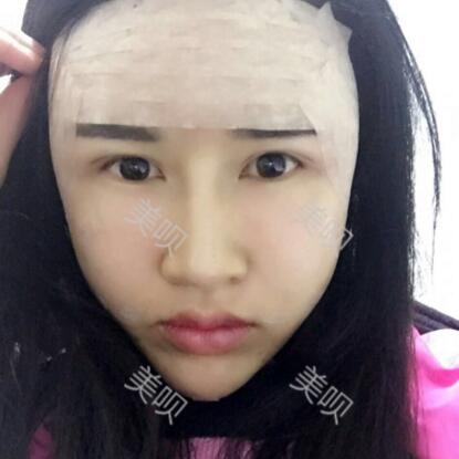 我做的面部年轻化自体脂肪面部填充大家看看怎么样