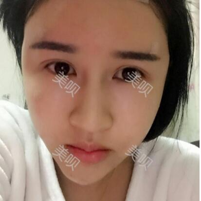 我做的面部年轻化自体脂肪面部填充大家看看怎么样