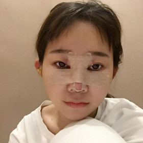 去年11月做的膨体隆鼻手术，终于摆脱我的塌鼻梁了