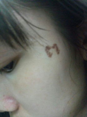 激光祛斑，还我靓白肌肤!