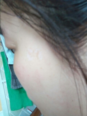 激光祛斑，还我靓白肌肤!