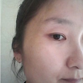 真人记录了彩光嫩肤前后过程，果真的还不错