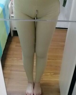 大腿抽脂的亲身经历，恢复情况还不错