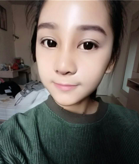 隆鼻整形日记，像变了个人似的