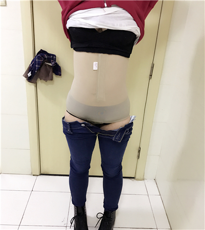 分享我的吸脂瘦腰腹手术经历，还有前后的照片哦~