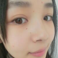 脸上激光去痣日志分享，一共去痣2次