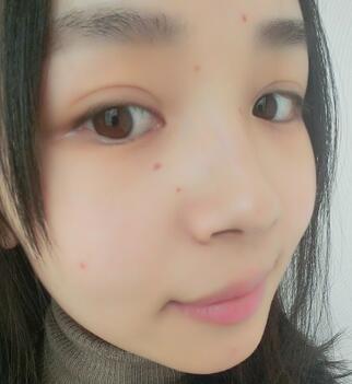 激光去痣第(一)天