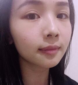 激光去痣恢复图