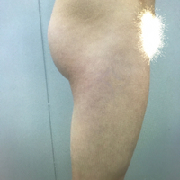 大腿抽脂瘦大腿恢复全过程我也有纤细的美腿了