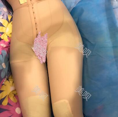 大腿抽脂瘦大腿恢复全过程我也有纤细的美腿了