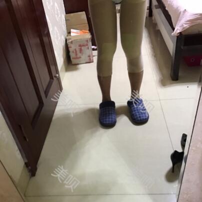 大腿抽脂瘦大腿恢复全过程我也有纤细的美腿了