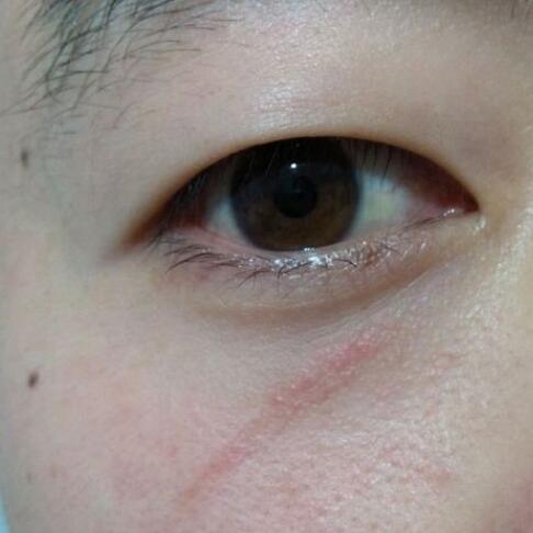 分享下我的手术切除祛疤过程路给大家做个参考