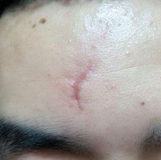 分享下我的手术切除祛疤过程路给大家做个参考