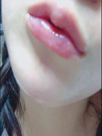 我做了玻尿酸丰唇和玻尿酸丰下巴 果还不错哦