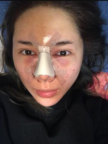 我的隆鼻整形加玻尿酸丰额头以及B****的真实经历