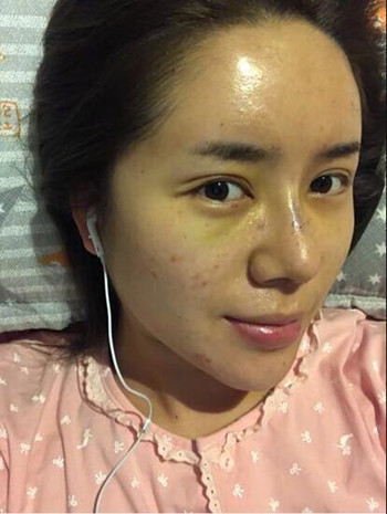 我的隆鼻整形加玻尿酸丰额头以及B****的真实经历