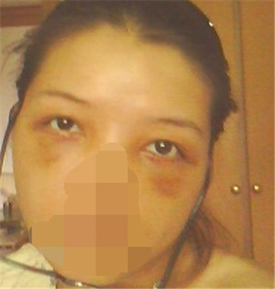 外切去眼袋手术过程和恢复前后对比照片分享，刘志飞医生做的~