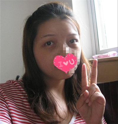 外切去眼袋手术过程和恢复前后对比照片分享，刘志飞医生做的~