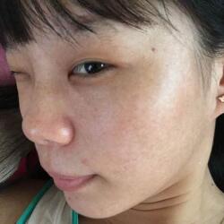 激光祛斑——雀斑后脸上终于白净了