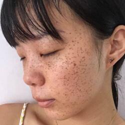 激光祛斑——雀斑后脸上终于白净了
