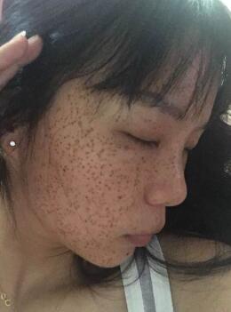 激光去雀斑术后照片