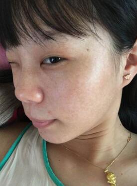 激光祛斑缓解果