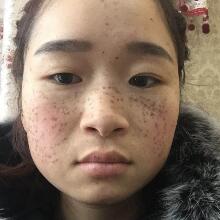 在南京光尔美医疗美容医院做的激光祛斑缓解分享