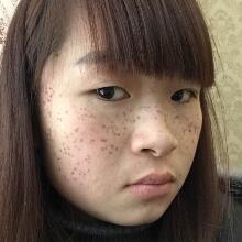 在南京光尔美医疗美容医院做的激光祛斑缓解分享