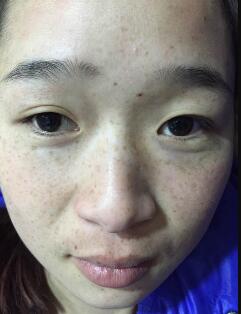 下图是激光祛斑之前的照片