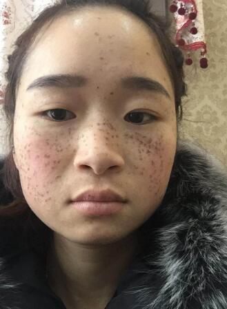 激光祛斑第二天开始结疤后的图片