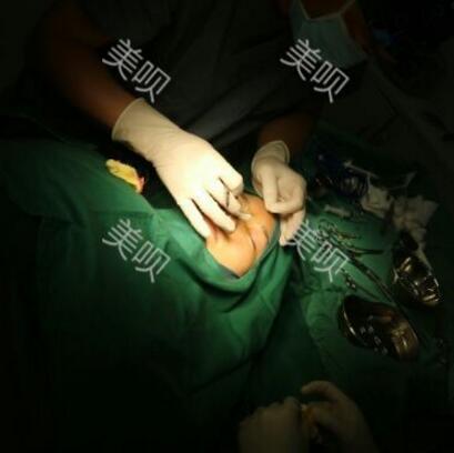 硅胶假体隆鼻+耳软骨垫鼻尖大家看看果还不错吧