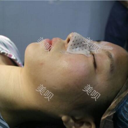 硅胶假体隆鼻+耳软骨垫鼻尖大家看看果还不错吧