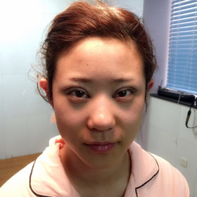 切开双眼皮+开内眼角手术前后过程，还有对比照片哟!