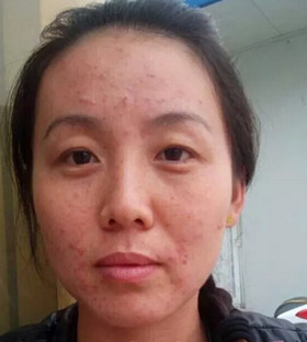 激光祛痘后终于让我摆脱了“痘友”行列!