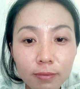 激光祛痘后终于让我摆脱了“痘友”行列!