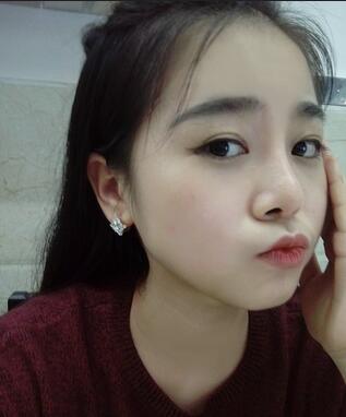 隆鼻整形日记 重庆铂生硅胶隆鼻＋耳软骨鼻尖