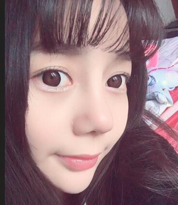 隆鼻修复术后恢复期经历