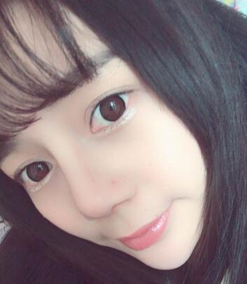 隆鼻修复术后恢复期经历