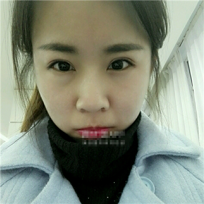 注射瘦脸去鱼尾纹恢复过程和前后对比果图片分享，上海东方做的~