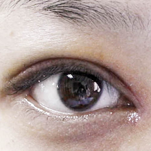 米兰柏羽做了外切去眼袋，分享手术前后对比果图片哦~