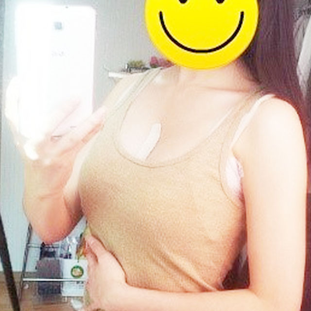 自体脂肪移植隆胸恢复过程和前后对比果图片分享哦~