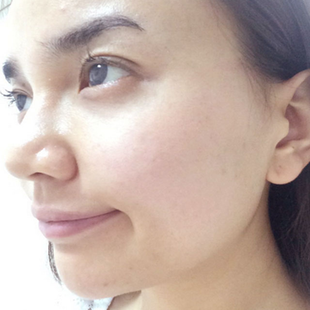 分享我的光子嫩肤经历，还有前后对比果照片哦~